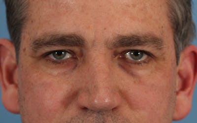 Blepharoplasty Before & After Gallery - Patient 122751080 - Image 1