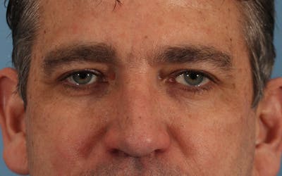 Blepharoplasty Before & After Gallery - Patient 122751080 - Image 2