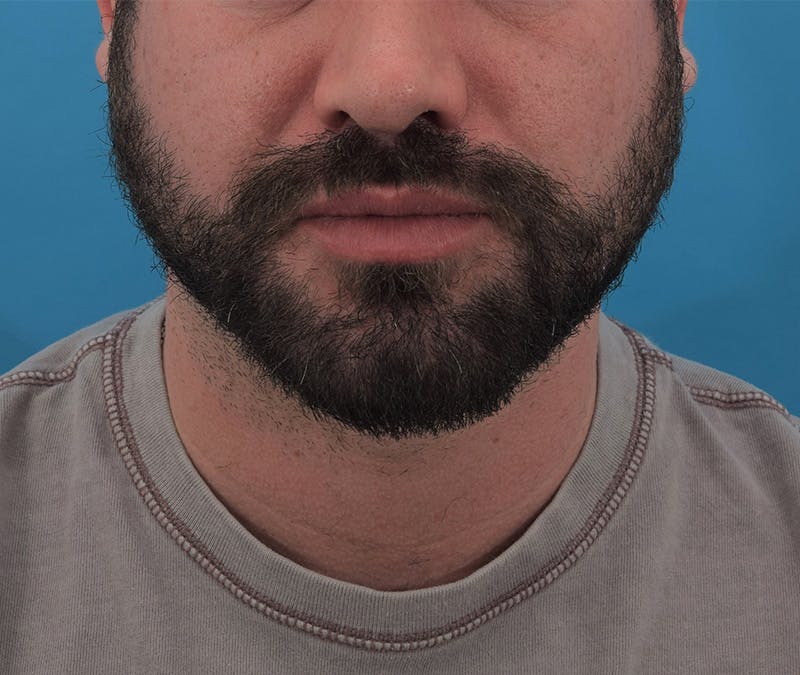 Buccal Fat Reduction Before & After Gallery - Patient 123090060 - Image 1