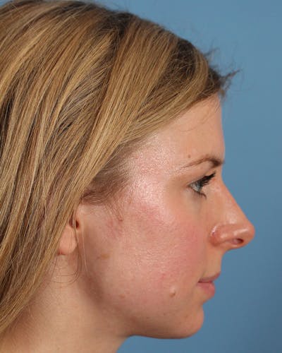 Rhinoplasty Before & After Gallery - Patient 123090133 - Image 1