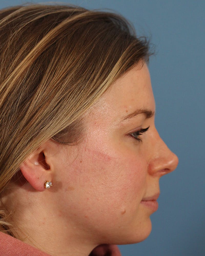 Rhinoplasty Before & After Gallery - Patient 123090133 - Image 2