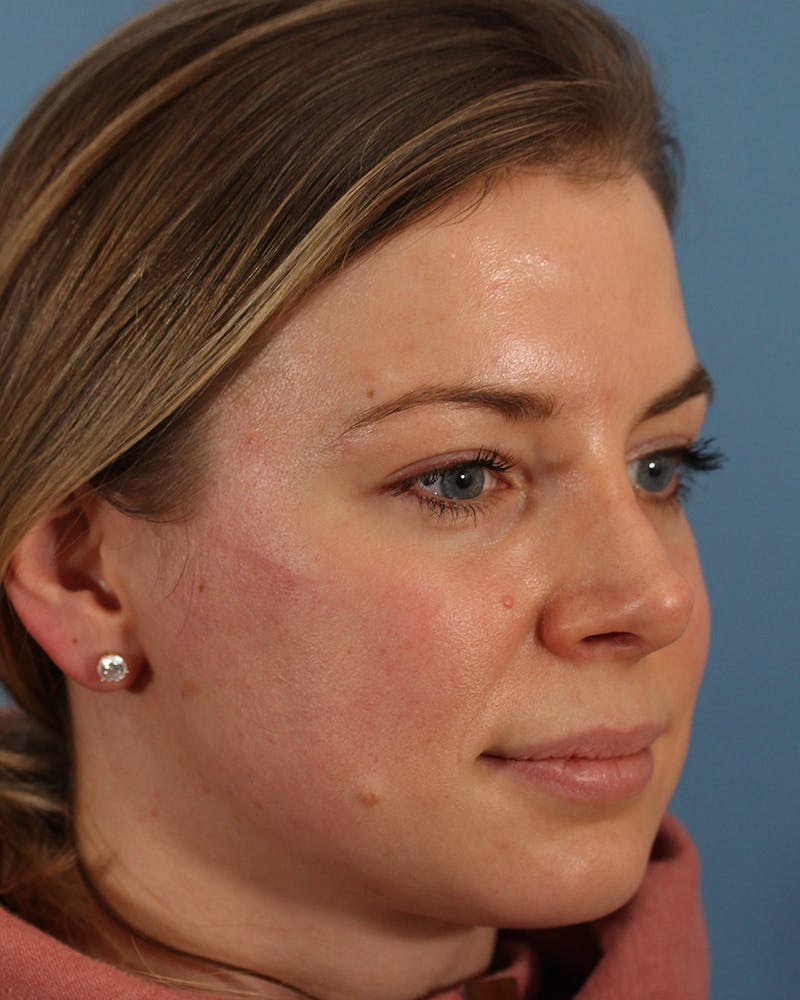 Rhinoplasty Before & After Gallery - Patient 123090133 - Image 4