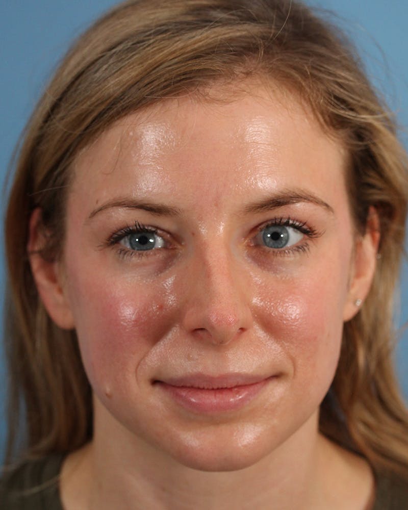 Rhinoplasty Before & After Gallery - Patient 123090133 - Image 5