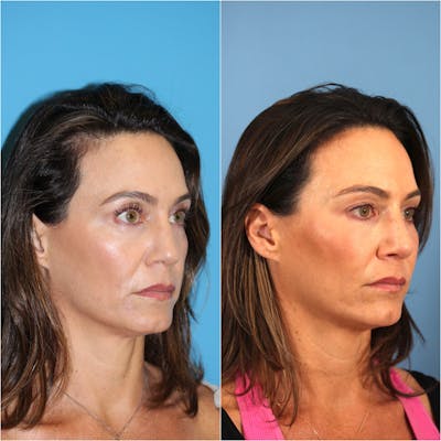 Blepharoplasty Before & After Gallery - Patient 123718801 - Image 1
