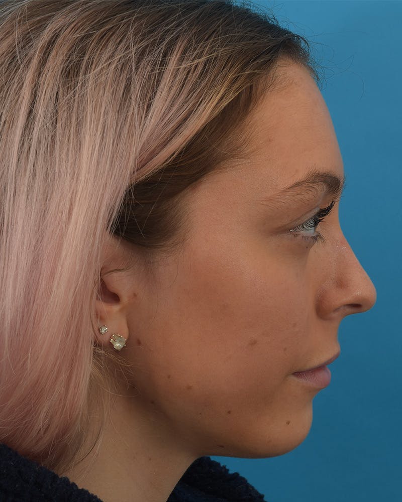 Rhinoplasty Before & After Gallery - Patient 123862295 - Image 1