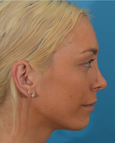 Rhinoplasty Before & After Gallery - Patient 123862295 - Image 2