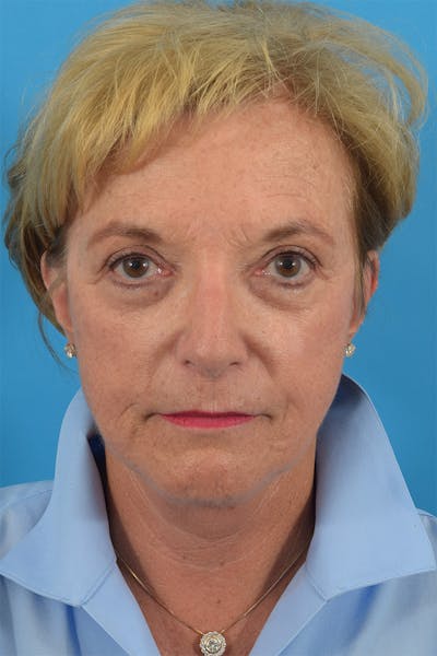 Blepharoplasty Before & After Gallery - Patient 141525544 - Image 1