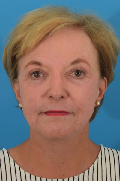 Blepharoplasty Before & After Gallery - Patient 141525544 - Image 2