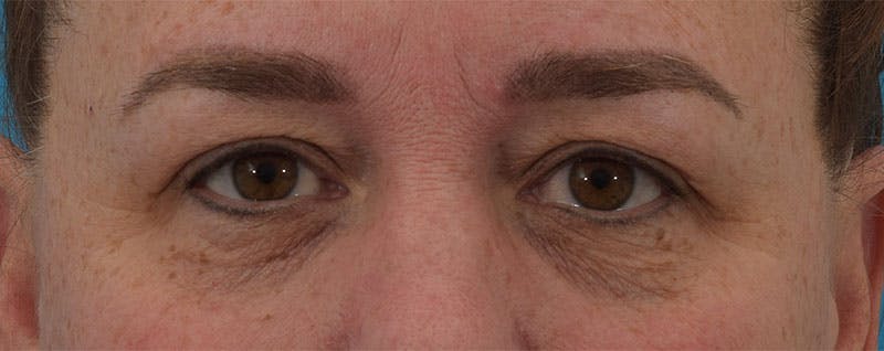 Laser Treatment Before & After Gallery - Patient 141595201 - Image 1