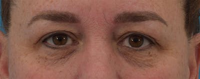 Skin Resurfacing Before & After Gallery - Patient 141595201 - Image 1