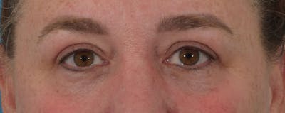 Blepharoplasty Before & After Gallery - Patient 141595182 - Image 2