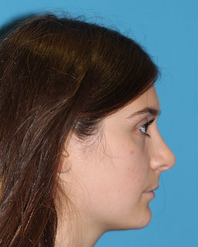 Rhinoplasty Before & After Gallery - Patient 142727293 - Image 2