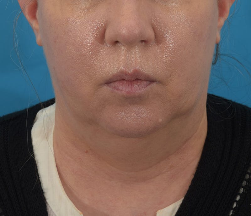 Facelift/Neck Lift Before & After Gallery - Patient 142762857 - Image 1