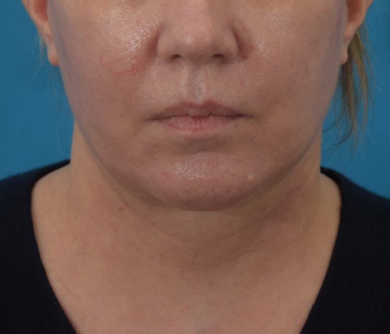 Chin Augmentation Before & After Gallery - Patient 142762858 - Image 2