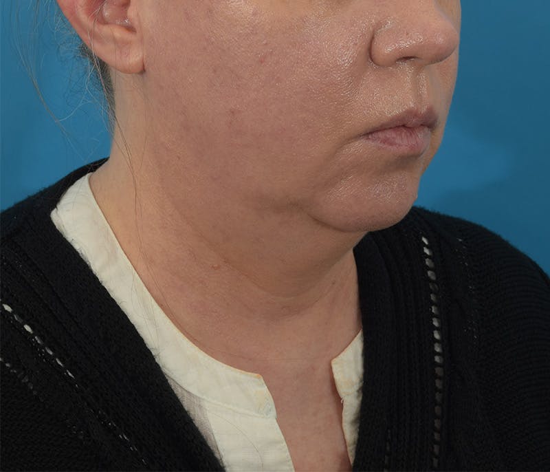 Facelift/Neck Lift Before & After Gallery - Patient 142762857 - Image 3