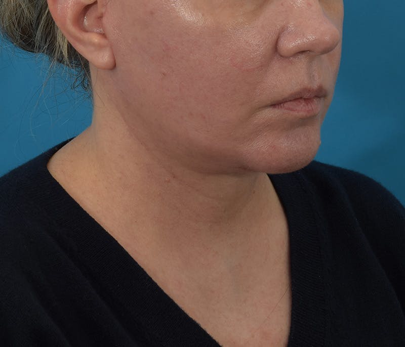 Chin Augmentation Before & After Gallery - Patient 142762858 - Image 4