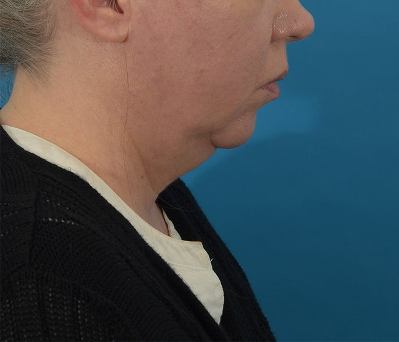 Facelift/Neck Lift Before & After Gallery - Patient 142762857 - Image 5