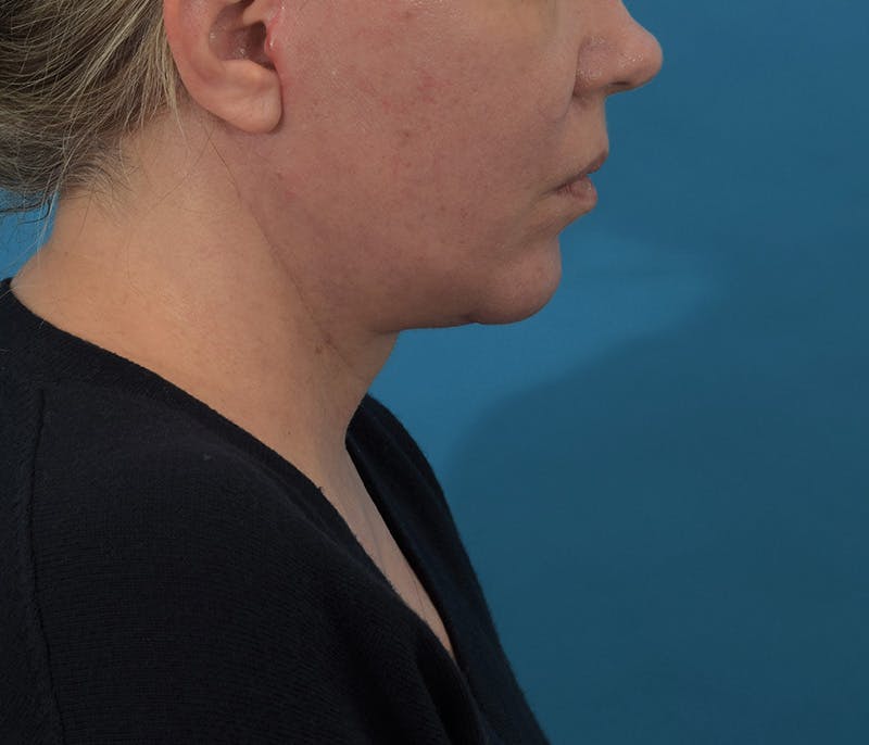 Chin Augmentation Before & After Gallery - Patient 142762858 - Image 6