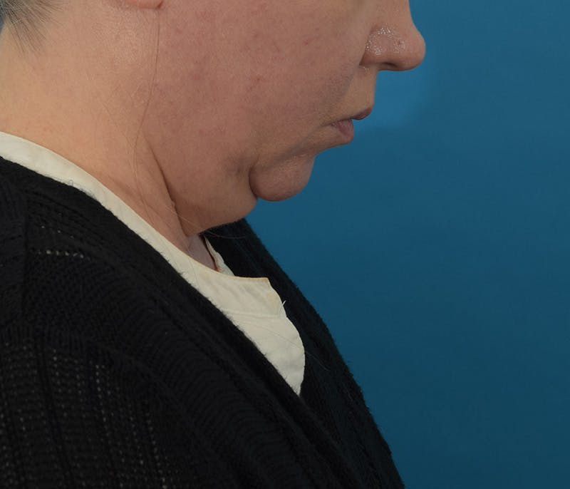 Facelift/Neck Lift Before & After Gallery - Patient 142762857 - Image 7