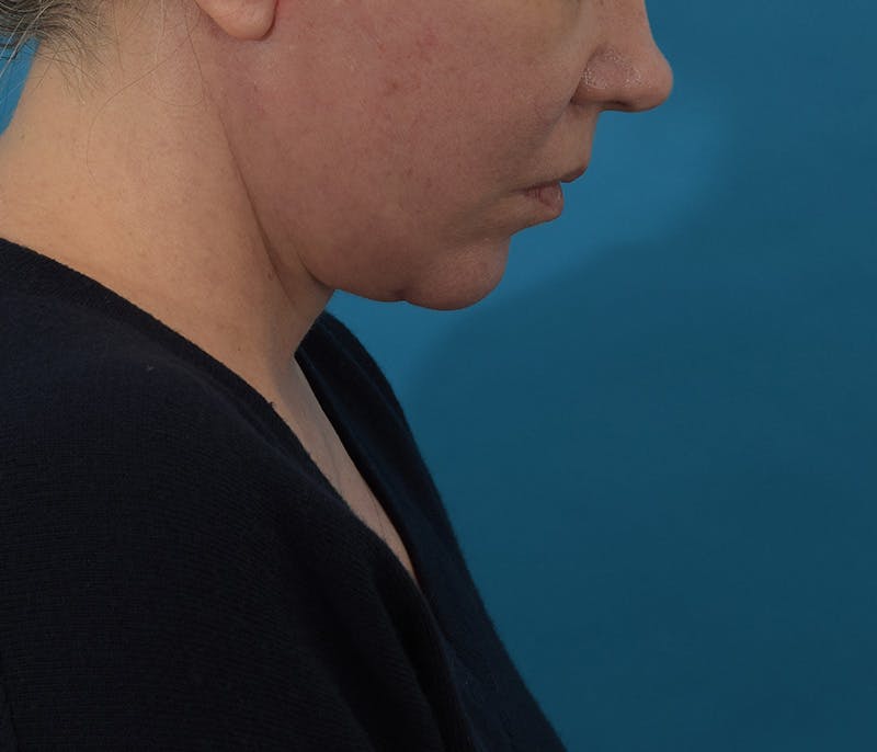 Chin Augmentation Before & After Gallery - Patient 142762858 - Image 8