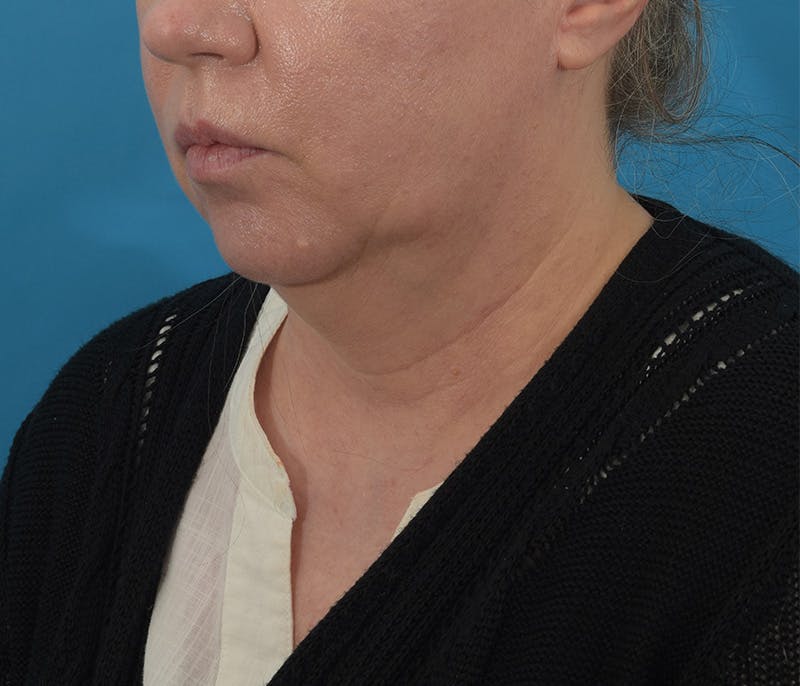 Chin Augmentation Before & After Gallery - Patient 142762858 - Image 9