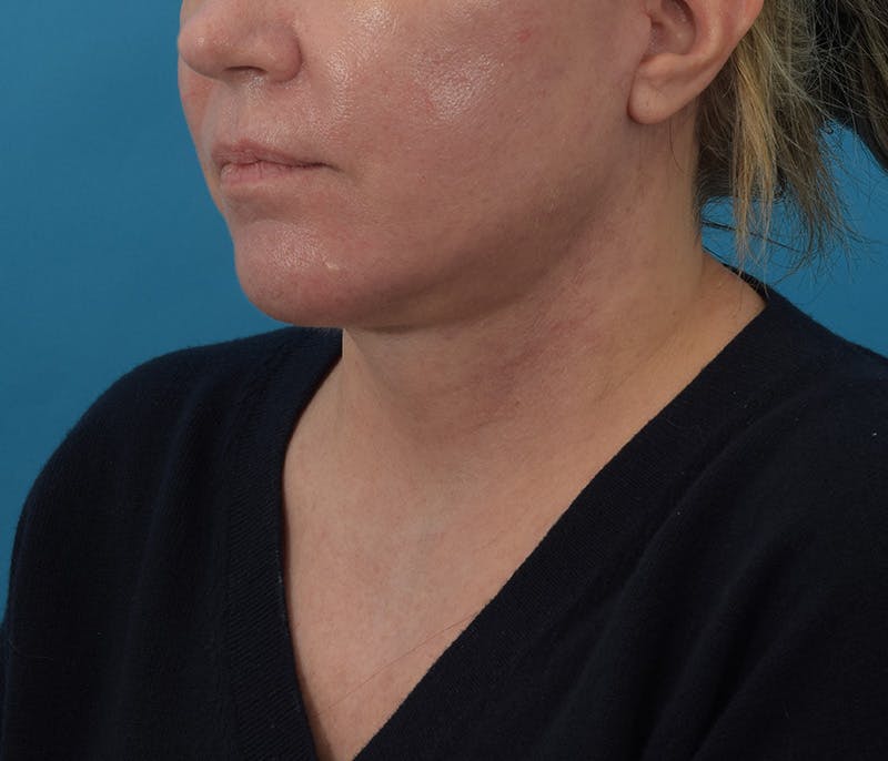 Facelift/Neck Lift Before & After Gallery - Patient 142762857 - Image 10