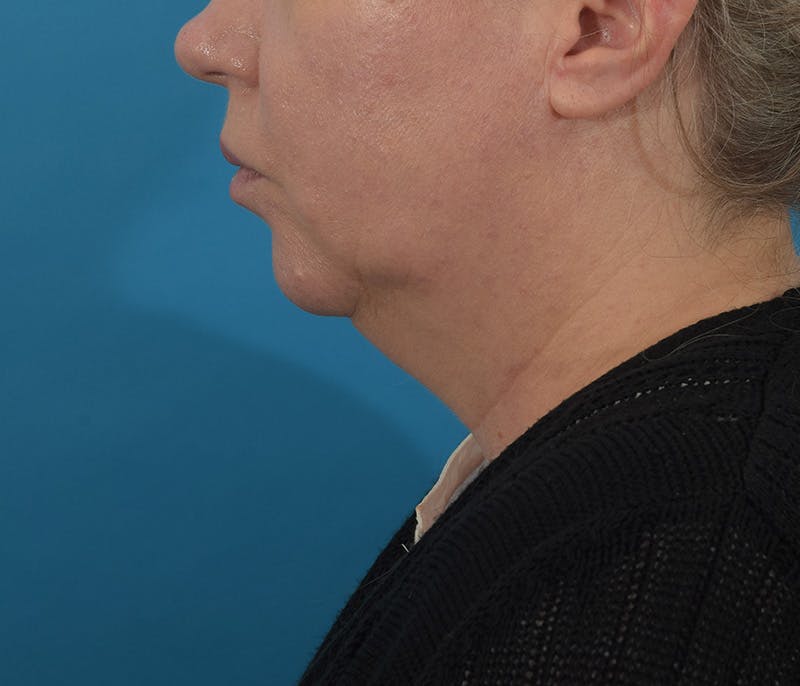 Facelift/Neck Lift Before & After Gallery - Patient 142762857 - Image 11
