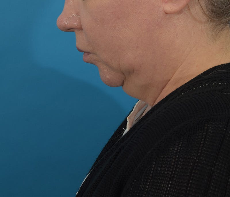 Facelift/Neck Lift Before & After Gallery - Patient 142762857 - Image 13