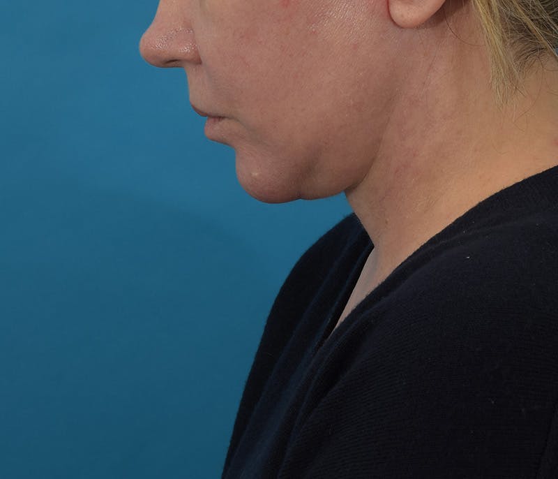 Chin Augmentation Before & After Gallery - Patient 142762858 - Image 14