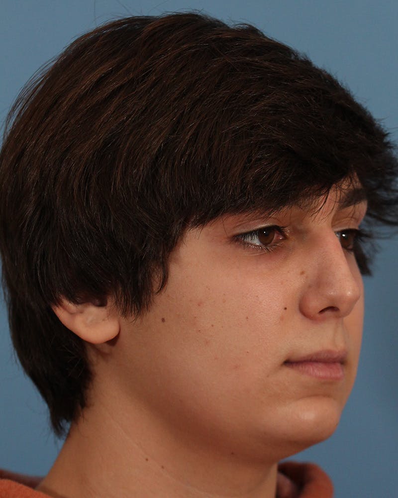 Chin Augmentation Before & After Gallery - Patient 142813640 - Image 5