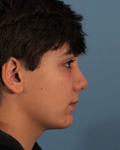 Rhinoplasty Before & After Gallery - Patient 142813638 - Image 2