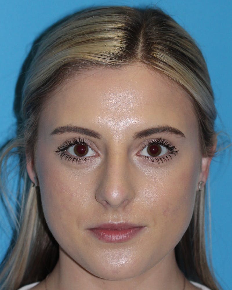 Rhinoplasty Before & After Gallery - Patient 143020535 - Image 3