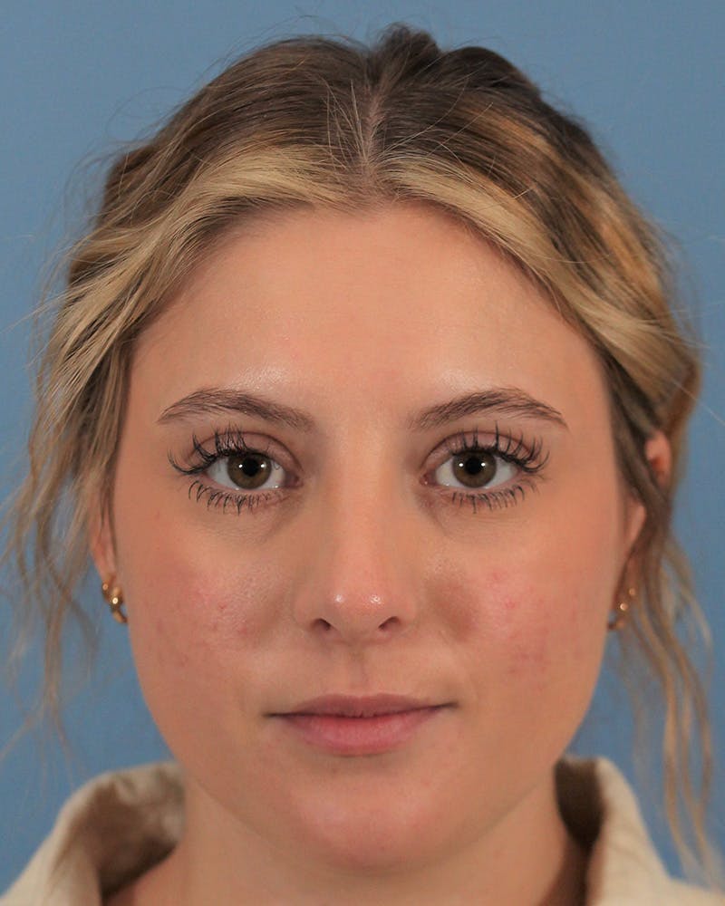 Rhinoplasty Before & After Gallery - Patient 143020535 - Image 4