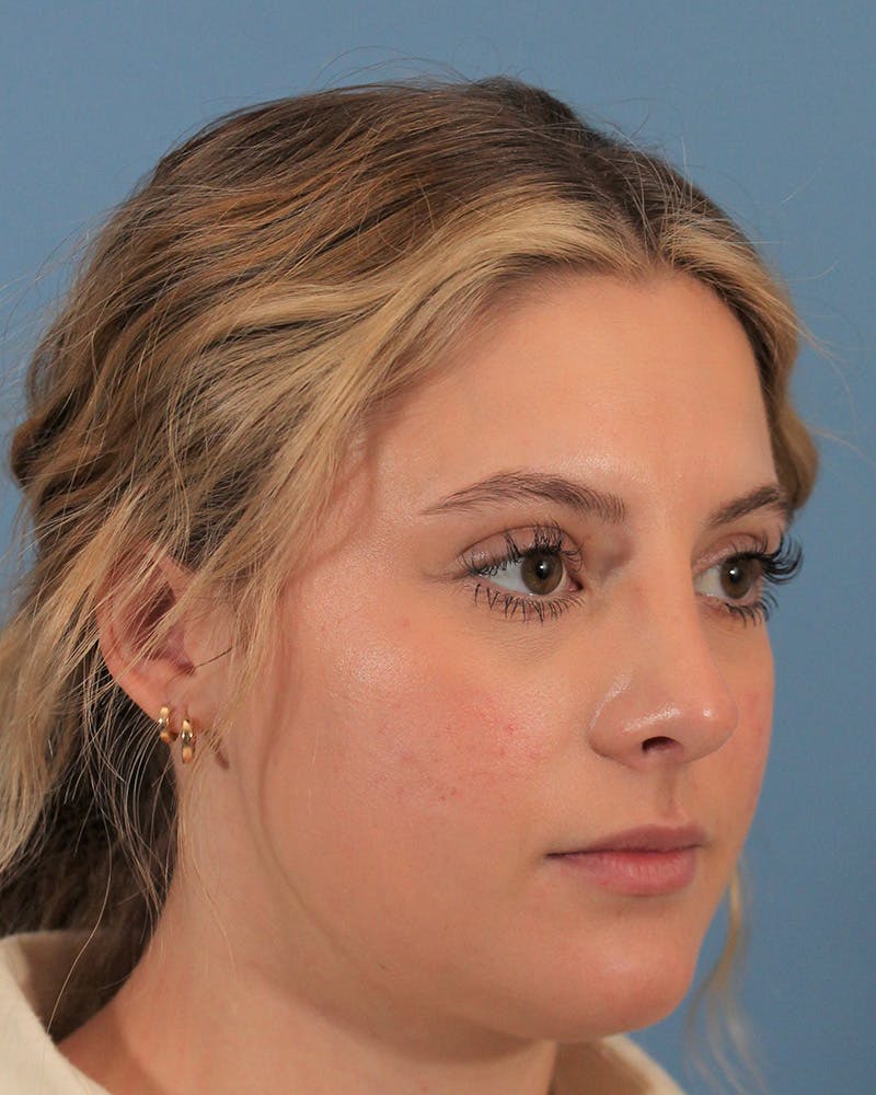 Rhinoplasty Before & After Gallery - Patient 143020535 - Image 6