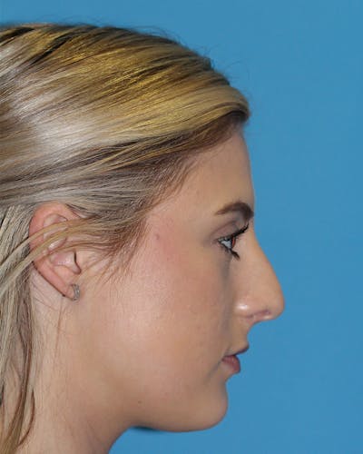Rhinoplasty Before & After Gallery - Patient 143020535 - Image 1