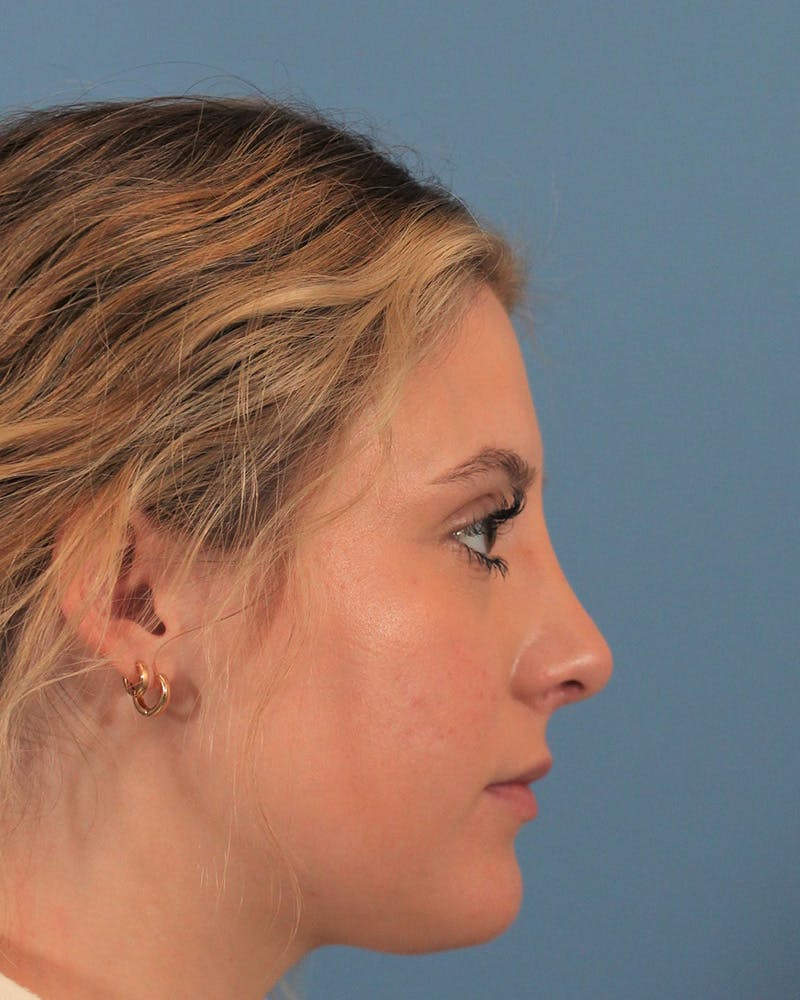 Rhinoplasty Before & After Gallery - Patient 143020535 - Image 2