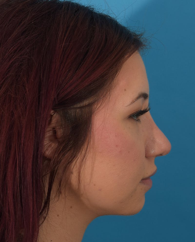 Rhinoplasty Before & After Gallery - Patient 143364425 - Image 6