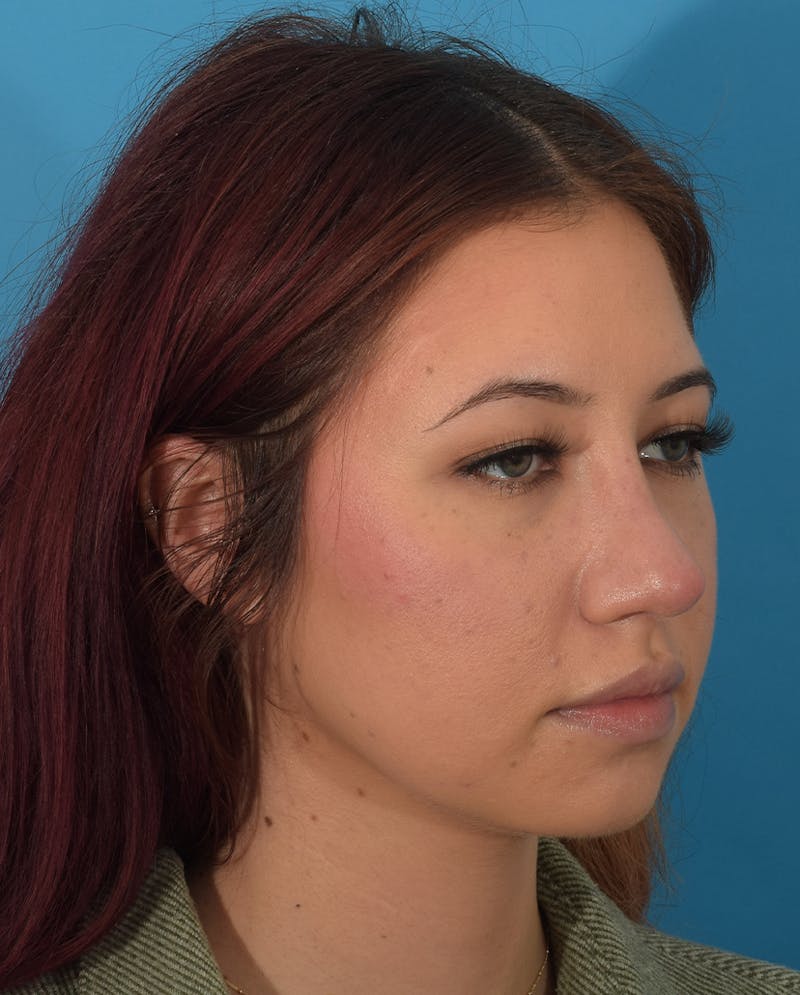 Rhinoplasty Before & After Gallery - Patient 143364425 - Image 6