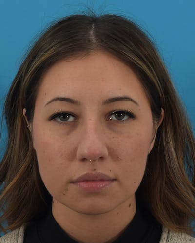 Rhinoplasty Before & After Gallery - Patient 143364425 - Image 1