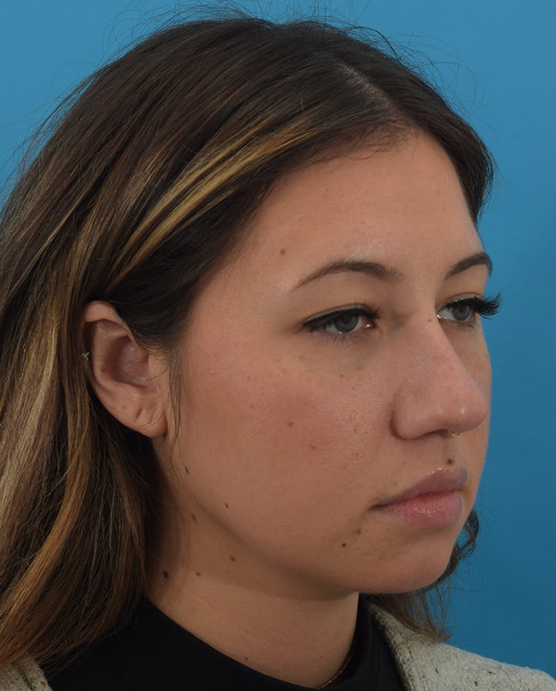 Rhinoplasty Before & After Gallery - Patient 143364425 - Image 3