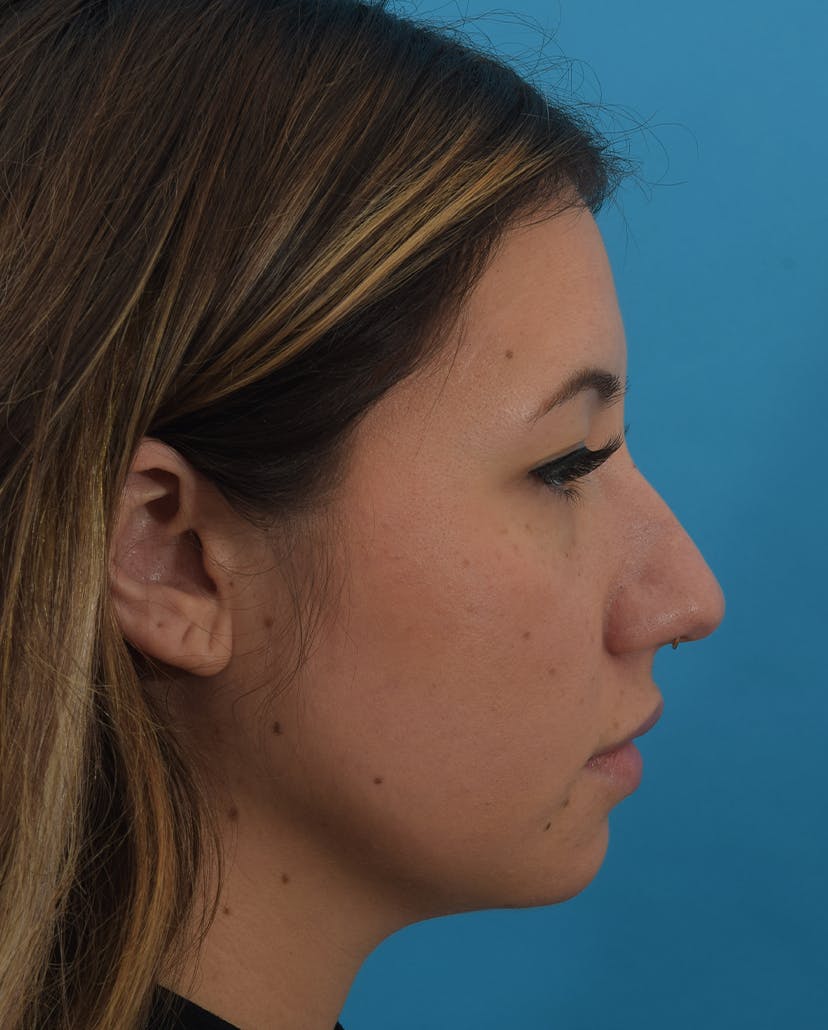 Dr. Frankel's Rhinoplasty in Cleveland Before and After 05