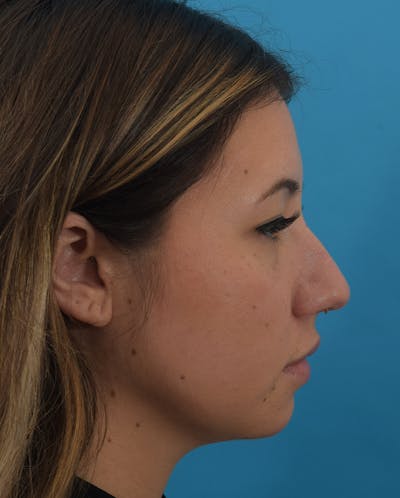 Rhinoplasty Before & After Gallery - Patient 143364425 - Image 1