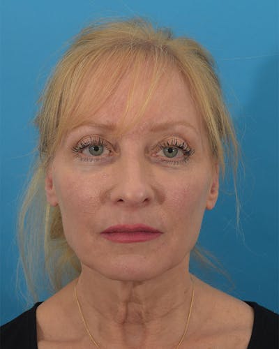 Facelift/Neck Lift Before & After Gallery - Patient 143648239 - Image 1