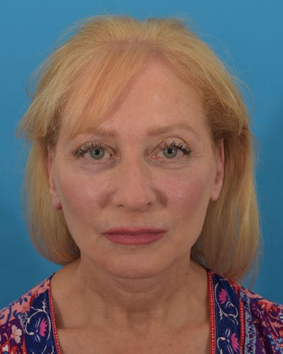 Facelift/Neck Lift Before & After Gallery - Patient 143648239 - Image 2