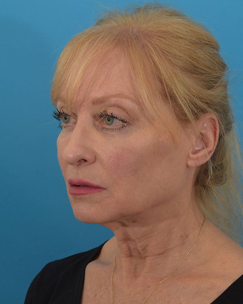 Facelift/Neck Lift Before & After Gallery - Patient 143648239 - Image 3