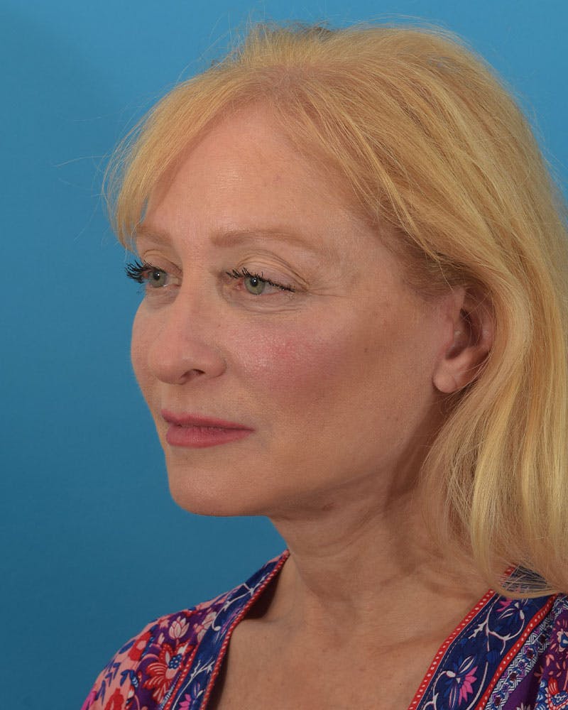 Facelift/Neck Lift Before & After Gallery - Patient 143648239 - Image 4