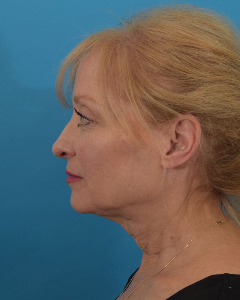 Facelift/Neck Lift Before & After Gallery - Patient 143648239 - Image 5