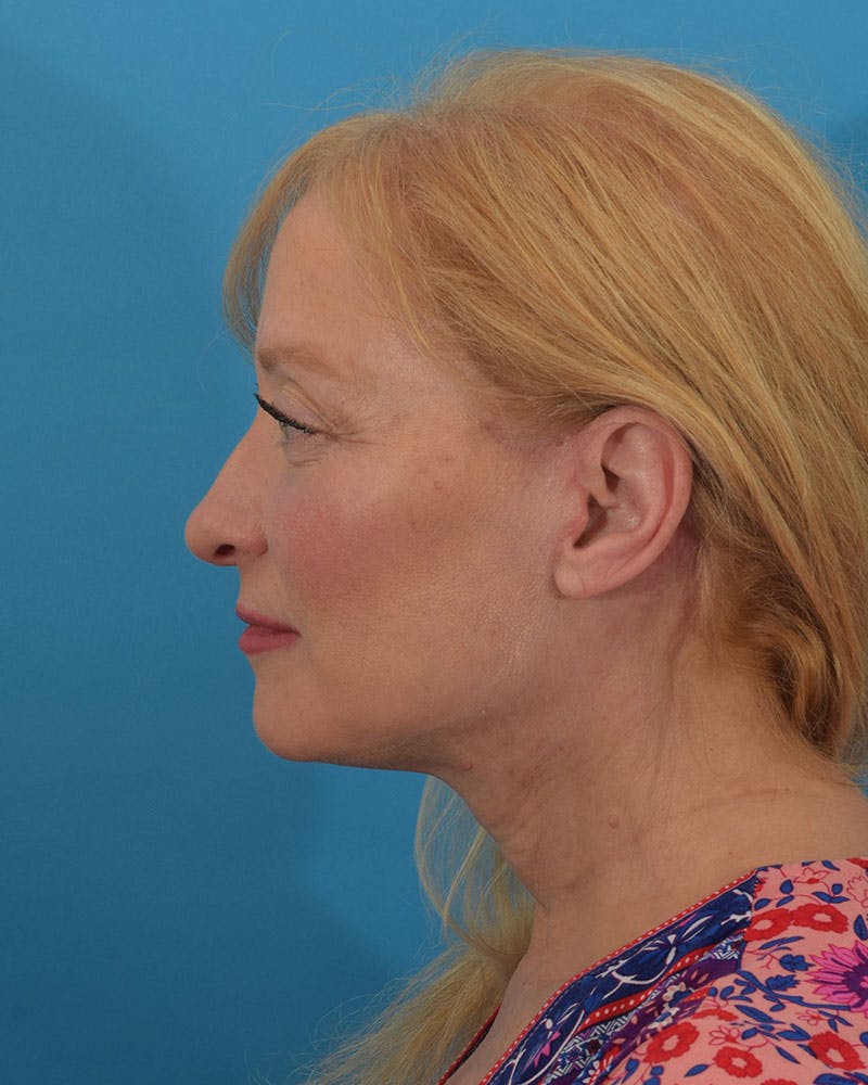 Facelift/Neck Lift Before & After Gallery - Patient 143648239 - Image 6