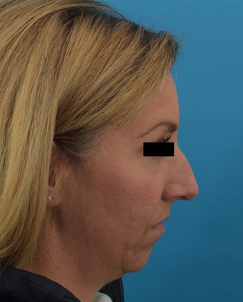 Rhinoplasty Before & After Gallery - Patient 144554833 - Image 1