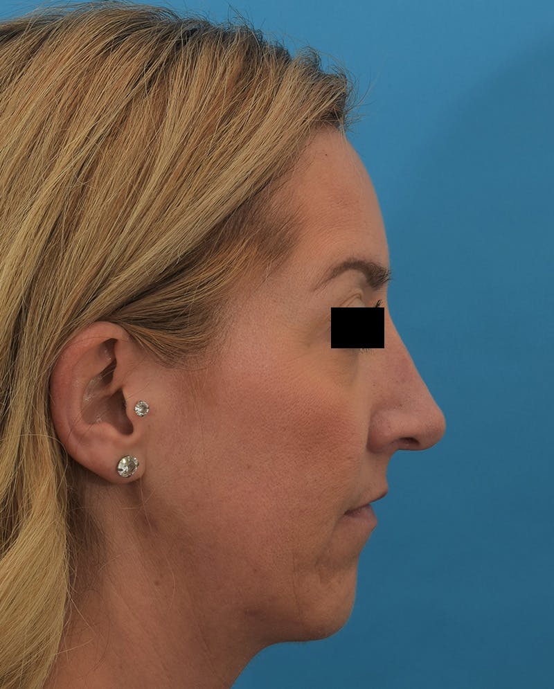 Rhinoplasty Before & After Gallery - Patient 144554833 - Image 2